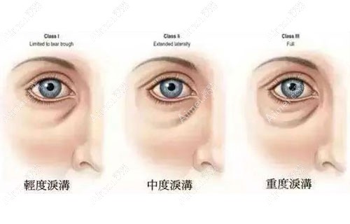 填泪沟用肤美达胶原蛋白和双美哪个好？两者有啥区别？