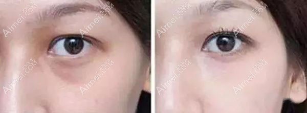 肤美达胶原蛋白去泪沟对比效果图.jpg