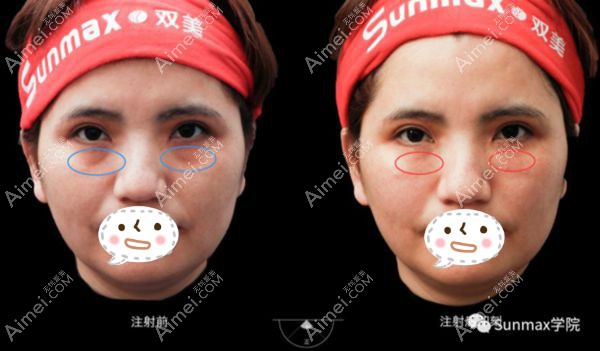 双美胶原蛋白肤丽美去泪沟的对比效果图.jpg