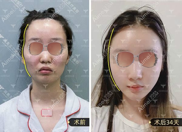 顾客在王明利医生做自体脂肪填充全脸1个月的对比照片.jpg 顾客在王明利医生做自体脂肪填充全脸1个月的对比照片.jpg