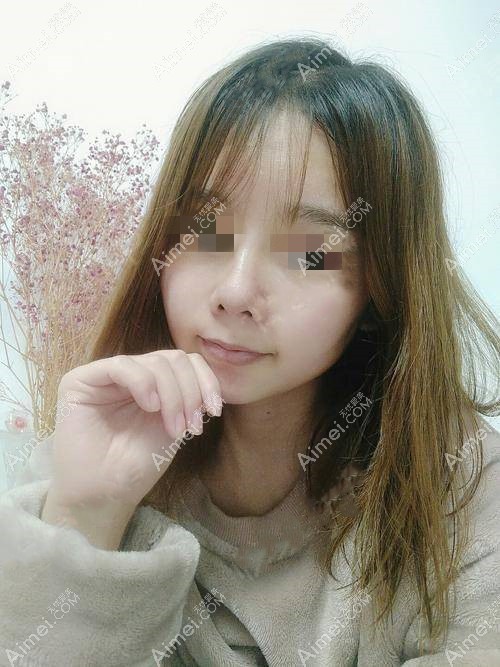 鼻综合术后半个月 鼻综合术后半个月