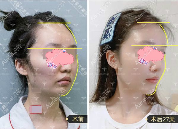 北京润美玉之光自体脂肪填充全脸27天后效果对比图.jpg 北京润美玉之光自体脂肪填充全脸27天后效果对比图.jpg
