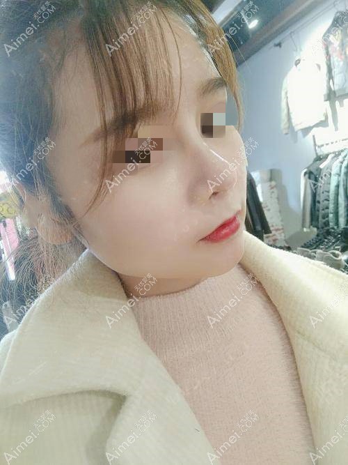 鼻综合术后二十多天 鼻综合术后二十多天