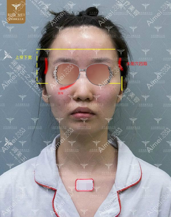 自体脂肪填充全脸术前正面照.jpg 自体脂肪填充全脸术前正面照.jpg