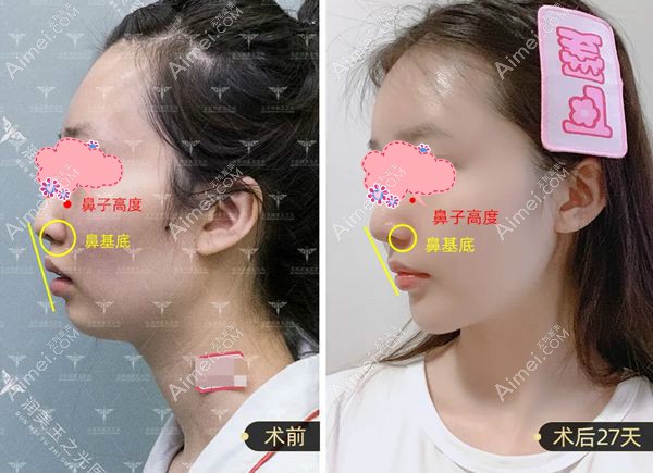 王明利在自体脂肪填充中改善鼻基底的术后效果图.jpg 王明利在自体脂肪填充中改善鼻基底的术后效果图.jpg