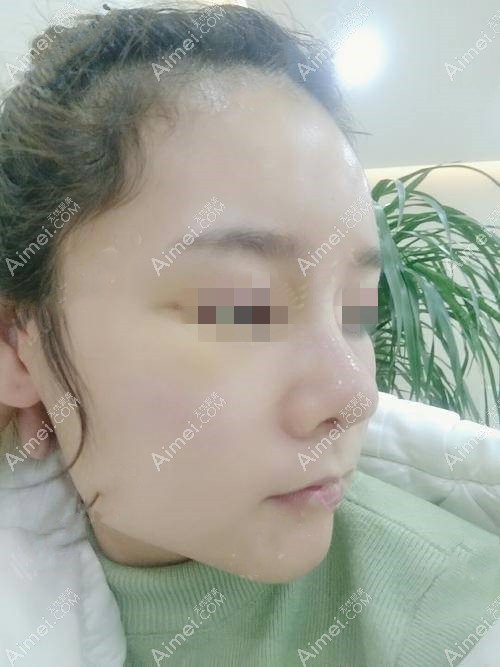鼻综合术后一周 鼻综合术后一周
