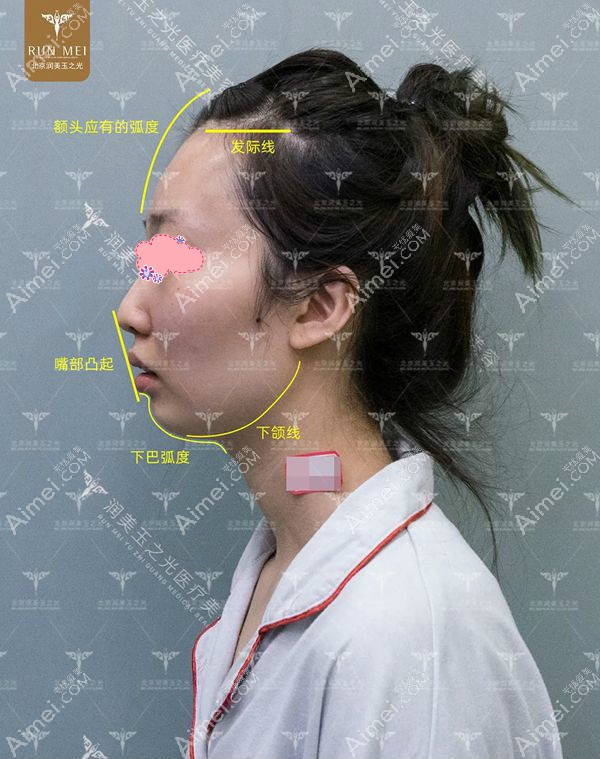 自体脂肪填充全脸术前侧面照.jpg 自体脂肪填充全脸术前侧面照.jpg