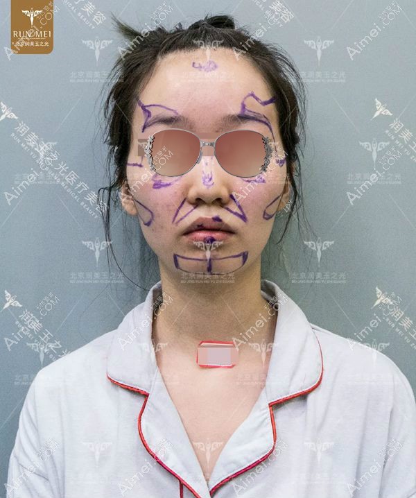王明利院长设计全脸自体脂肪填充方案.jpg 王明利院长设计全脸自体脂肪填充方案.jpg