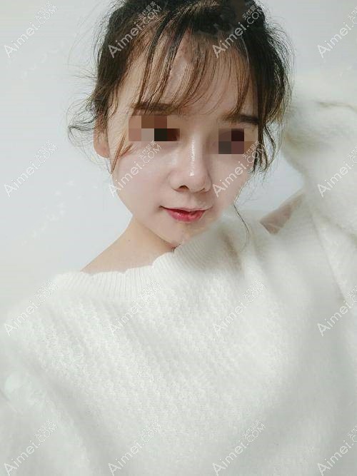 鼻综合术后一个月 鼻综合术后一个月