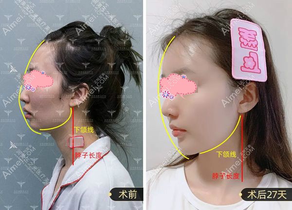 北京润美玉之光王明利院长做自体脂肪填充全脸侧面27天效果.jpg 北京润美玉之光王明利院长做自体脂肪填充全脸侧面27天效果.jpg