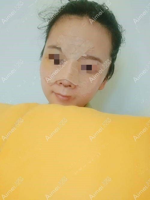 鼻综合术后一周 鼻综合术后一周
