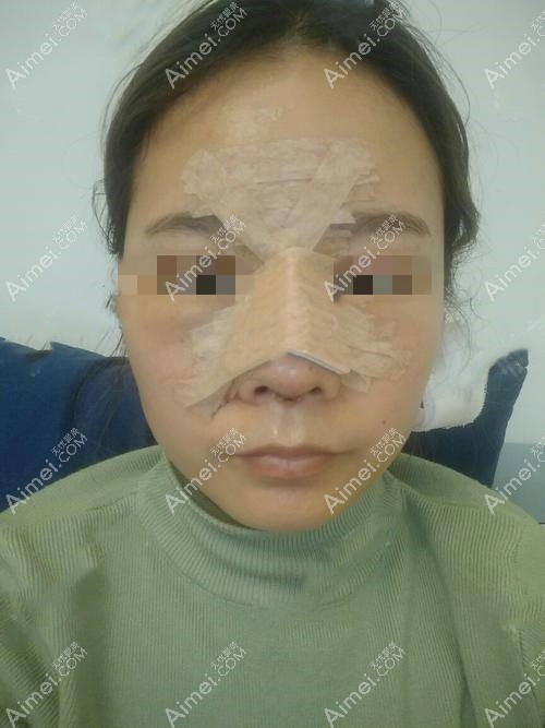 鼻综合术后即刻 鼻综合术后即刻