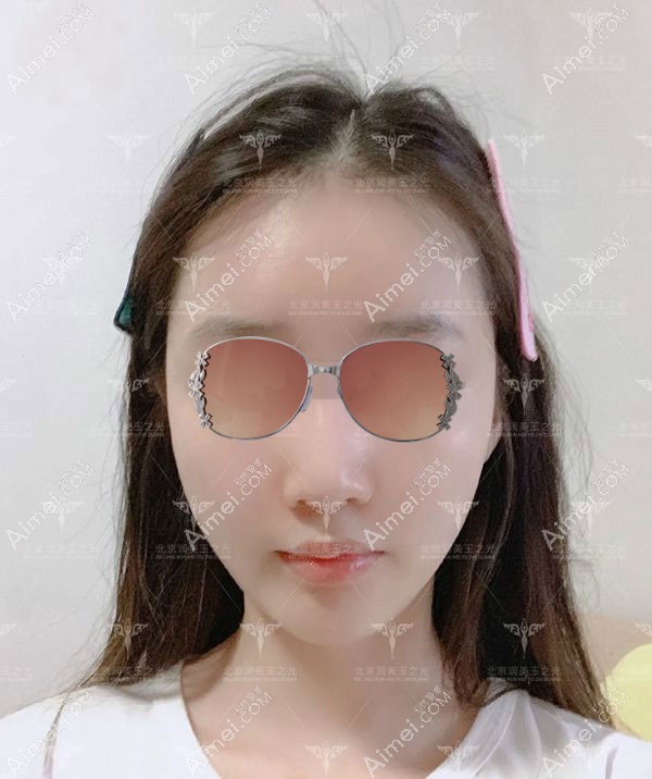 北京润美玉之光自体脂肪全脸填充34天无肿胀效果图.jpg 北京润美玉之光自体脂肪全脸填充34天无肿胀效果图.jpg