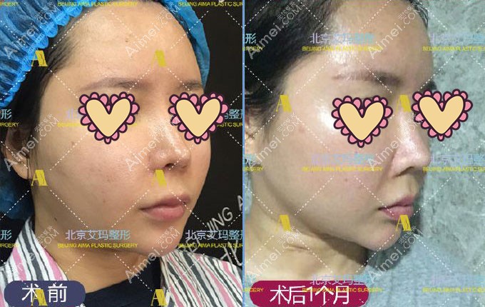 北京艾玛取面部生长因子术前术后对比效果图.jpg 北京艾玛取面部生长因子术前术后对比效果图.jpg