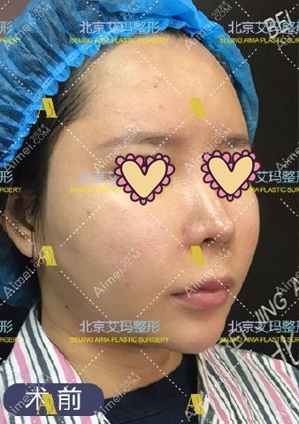 面部注射生长因子术前照片.jpg 面部注射生长因子术前照片.jpg