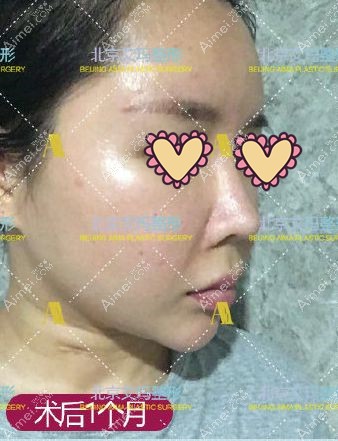 面部注射生长因子取出1个月效果图.jpg 面部注射生长因子取出1个月效果图.jpg