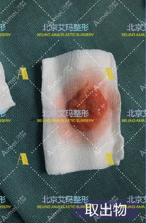 面部注射生长因子取出物图片.jpg 面部注射生长因子取出物图片.jpg