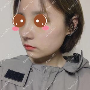 找付俊俐医生做膨体隆鼻术后8天 找付俊俐医生做膨体隆鼻术后8天