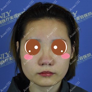 找付俊俐医生做膨体隆鼻术前 找付俊俐医生做膨体隆鼻术前