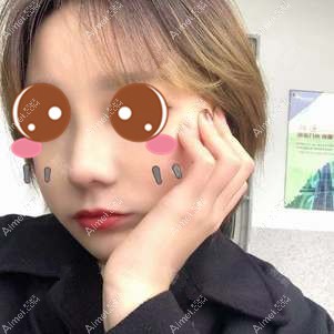 找付俊俐医生做膨体隆鼻术后15天 找付俊俐医生做膨体隆鼻术后15天