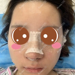 找付俊俐医生做膨体隆鼻手术当天 找付俊俐医生做膨体隆鼻手术当天