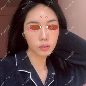 在武汉亚韩做颧骨颧骨手术后1个月 在武汉亚韩做颧骨颧骨手术后1个月