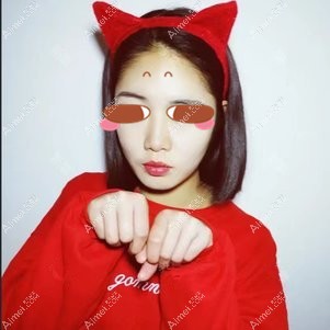 在武汉亚韩做颧骨颧骨手术后4个月 在武汉亚韩做颧骨颧骨手术后4个月
