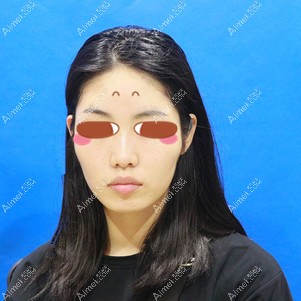 在武汉亚韩做颧骨颧骨手术前 在武汉亚韩做颧骨颧骨手术前