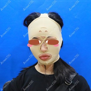 在武汉亚韩做颧骨颧骨手术后8天 在武汉亚韩做颧骨颧骨手术后8天