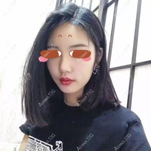 在武汉亚韩做颧骨颧骨手术后2个月 在武汉亚韩做颧骨颧骨手术后2个月