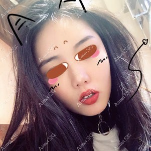 在武汉亚韩做颧骨颧骨手术后半年 在武汉亚韩做颧骨颧骨手术后半年