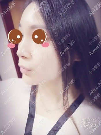 在黄石中爱注射玻尿酸隆鼻和下巴术后1个月 在黄石中爱注射玻尿酸隆鼻和下巴术后1个月