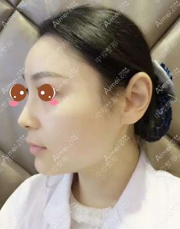 在黄石中爱注射玻尿酸隆鼻和下巴即刻效果 在黄石中爱注射玻尿酸隆鼻和下巴即刻效果