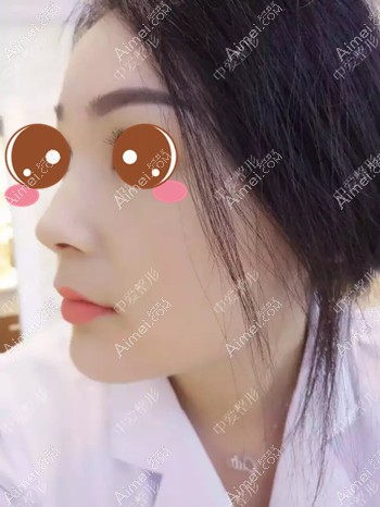 在黄石中爱注射玻尿酸隆鼻和下巴术后2天 在黄石中爱注射玻尿酸隆鼻和下巴术后2天