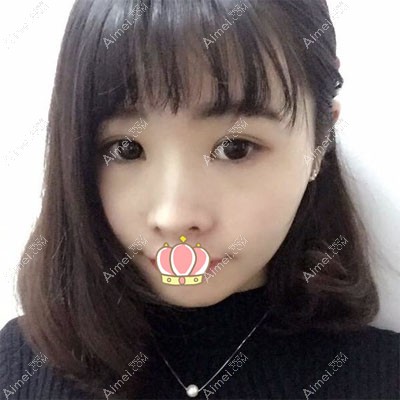 内江双眼皮手术哪里好?达芬奇案例 内江双眼皮手术哪里好?达芬奇案例