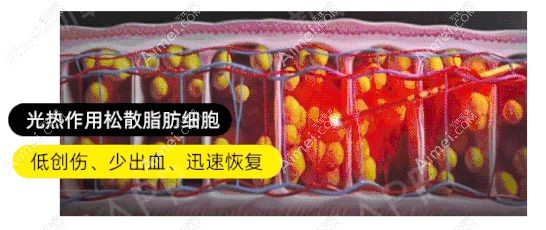 5g天使光雕吸脂后出血少,<span style= 5g天使光雕吸脂后出血少,<span style=