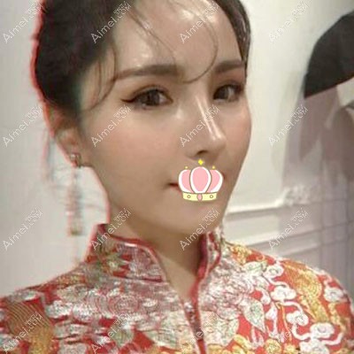 膨体隆鼻多久才稳定不会感染?4个月恢复照片 膨体隆鼻多久才稳定不会感染?4个月恢复照片