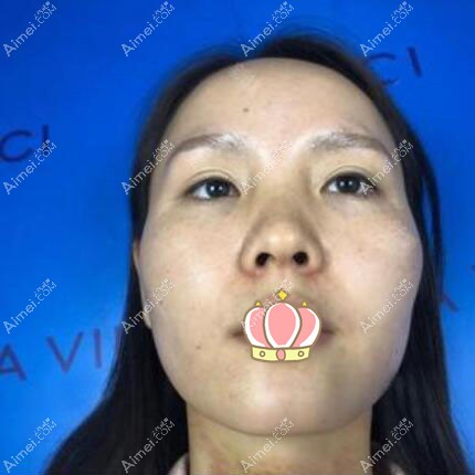 乐山达芬奇膨体隆鼻真人案例 乐山达芬奇膨体隆鼻真人案例