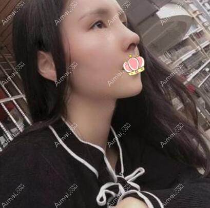 乐山达芬奇8毫米膨体鼻子图片 乐山达芬奇8毫米膨体鼻子图片