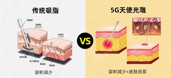 北京润美玉之光5g天使光雕溶脂和传统吸脂的对比.jpg 北京润美玉之光5g天使光雕溶脂和传统吸脂的对比.jpg