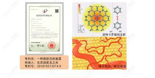 北京润美玉之光在吸脂专有技术<span style= 北京润美玉之光在吸脂专有技术<span style=