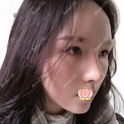 膨体隆鼻术后12天恢复照片 膨体隆鼻术后12天恢复照片