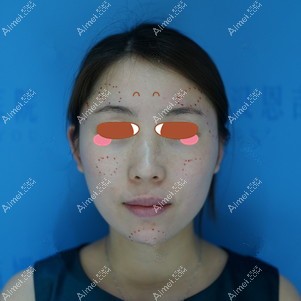找陈鹫院长做全脸脂肪填充前设计 找陈鹫院长做全脸脂肪填充前设计