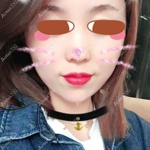 找陈鹫院长做全脸脂肪填充术后16天 找陈鹫院长做全脸脂肪填充术后16天