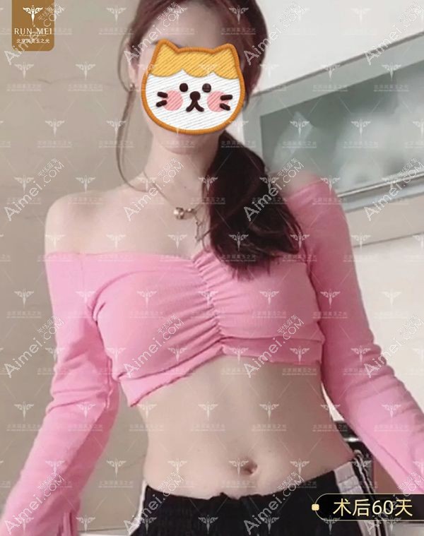 腰腹环吸2个月后腹部平坦无反弹.jpg 腰腹环吸2个月后腹部平坦无反弹.jpg