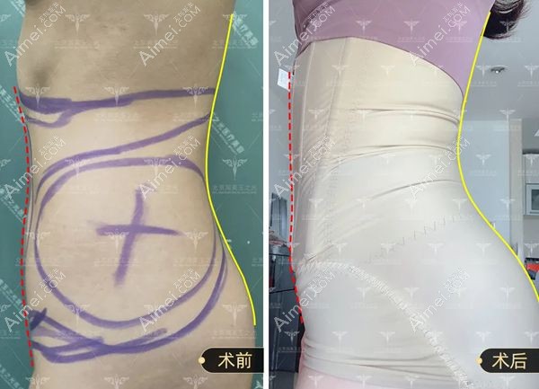 腰腹环吸2个月穿塑身衣侧腰曲线对比明显.jpg 腰腹环吸2个月穿塑身衣侧腰曲线对比明显.jpg
