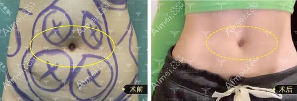 腰腹吸脂2000ml45天的术前术后对比图.jpg