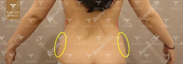 腰腹吸脂术前设计检测侧腰脂肪含量.jpg 腰腹吸脂术前设计检测侧腰脂肪含量.jpg