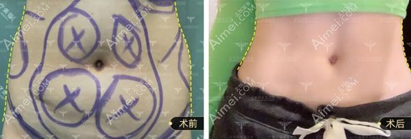 多维立体腰腹吸脂45天腰线对比效果图.jpg 多维立体腰腹吸脂45天腰线对比效果图.jpg