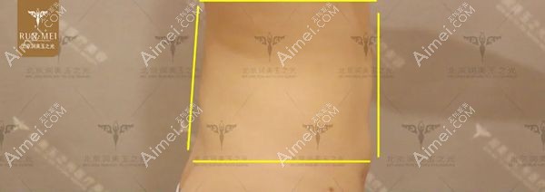 腰腹吸脂术前顾客侧面腰围呈正方形.jpg 腰腹吸脂术前顾客侧面腰围呈正方形.jpg